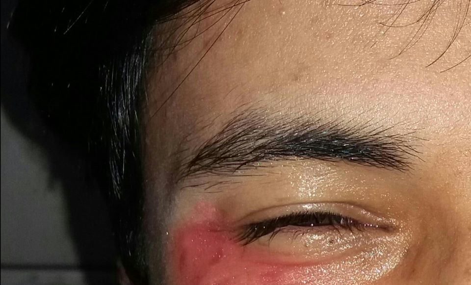 Neste domingo, dia 24, fez quatro meses que Leonardo Paim, foi agredido por ser homossexual, em Caxias do Sul. Foto: Reprodução