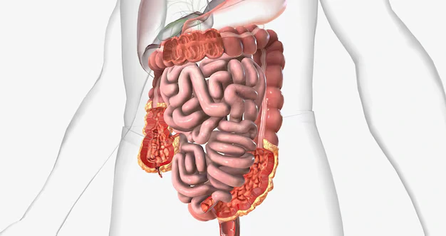 doença de Crohn Evaristo Costa