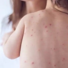 A maioria dos casos é atribuída ao sorogrupo B da bactéria Neisseria Meningitidis. (Foto: Reprodução)