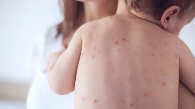 A maioria dos casos é atribuída ao sorogrupo B da bactéria Neisseria Meningitidis. (Foto: Reprodução)