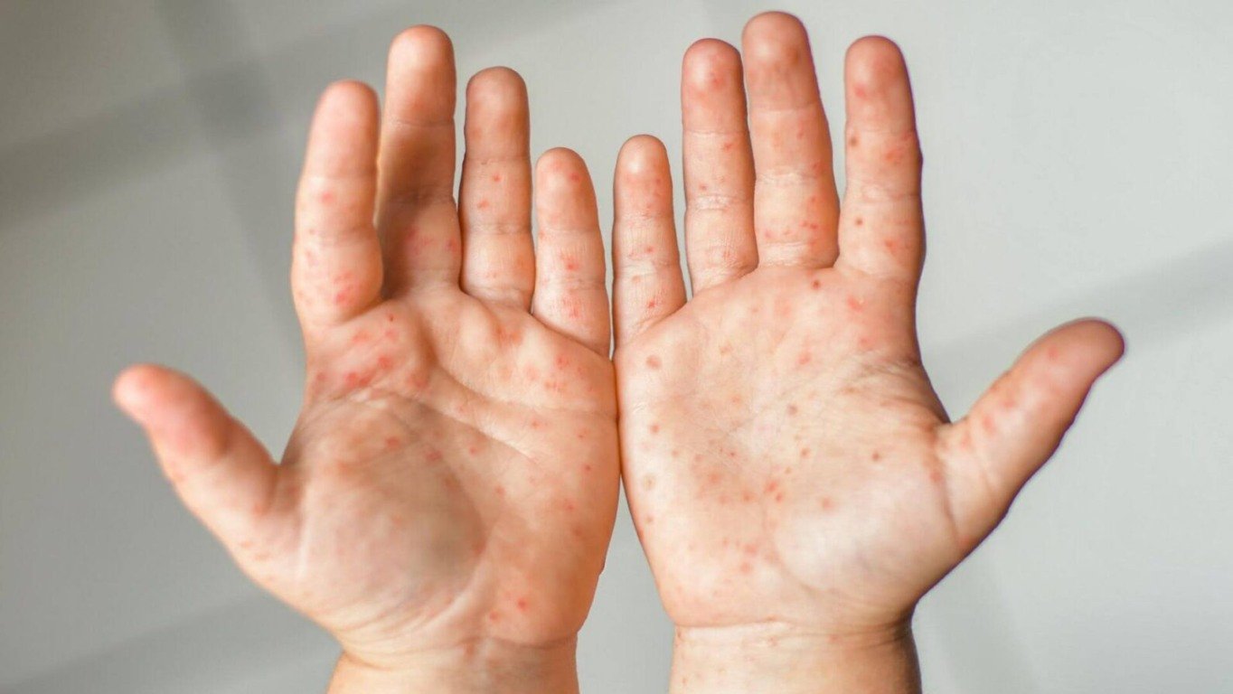 Os sintomas, geralmente, surgem entre três e sete dias após o contágio. (Foto: Reprodução)