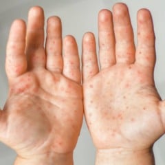 Os sintomas, geralmente, surgem entre três e sete dias após o contágio. (Foto: Reprodução)