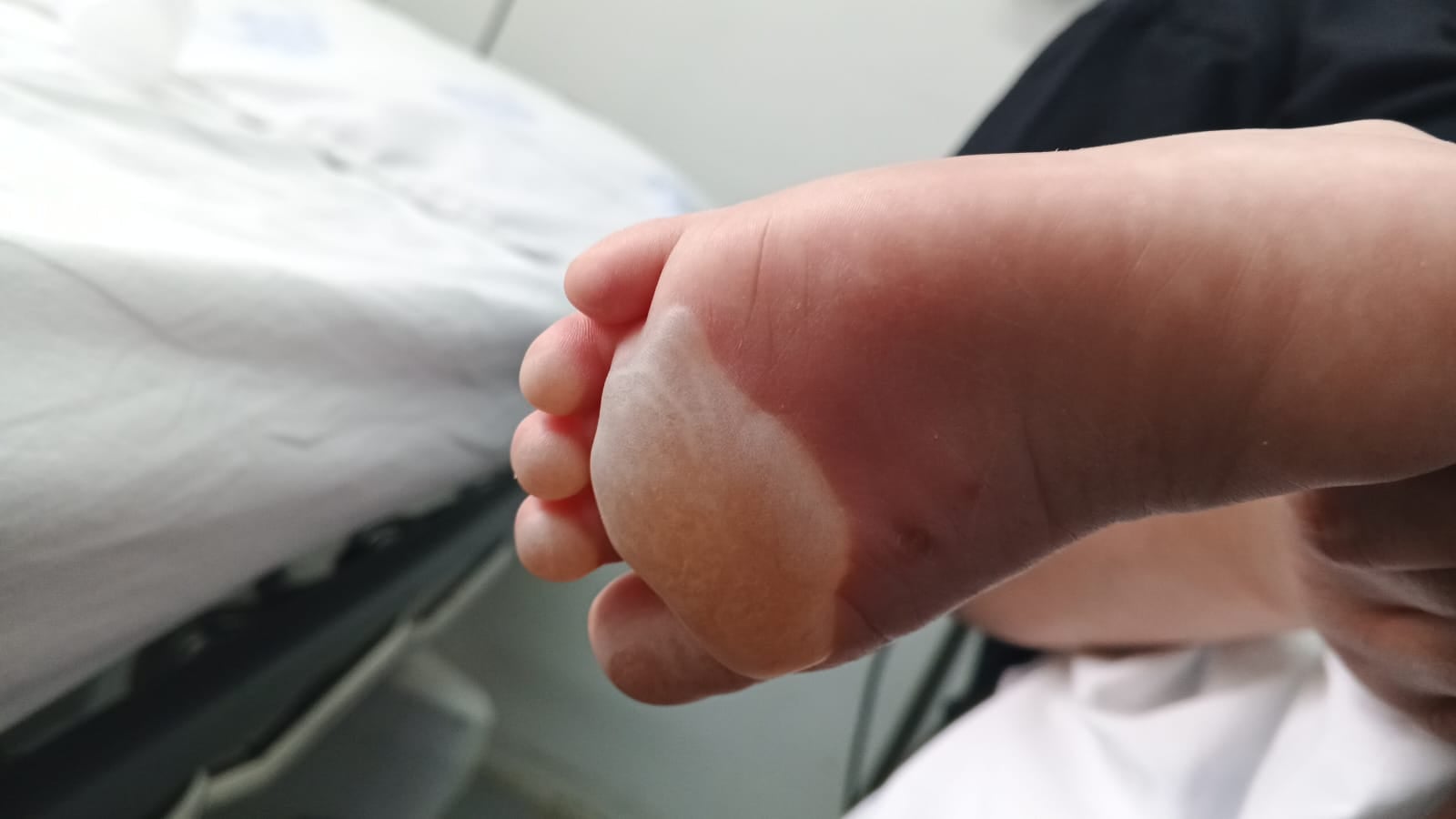 Mãe denuncia queimaduras em bebê de 1 ano e 11 meses em escola municipal de Farroupilha