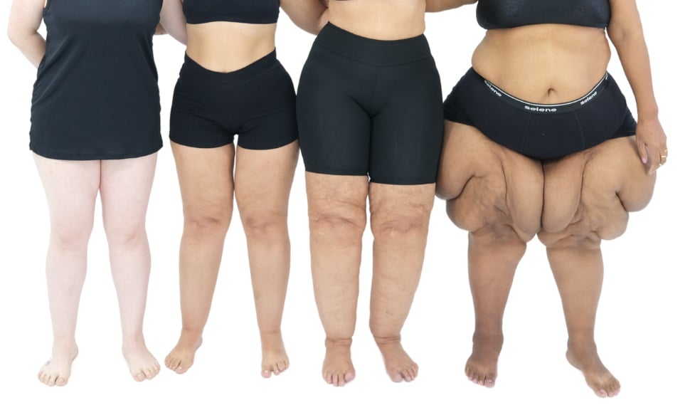 (Foto: ONG Movimento Lipedema) (Foto: ONG Movimento Lipedema)